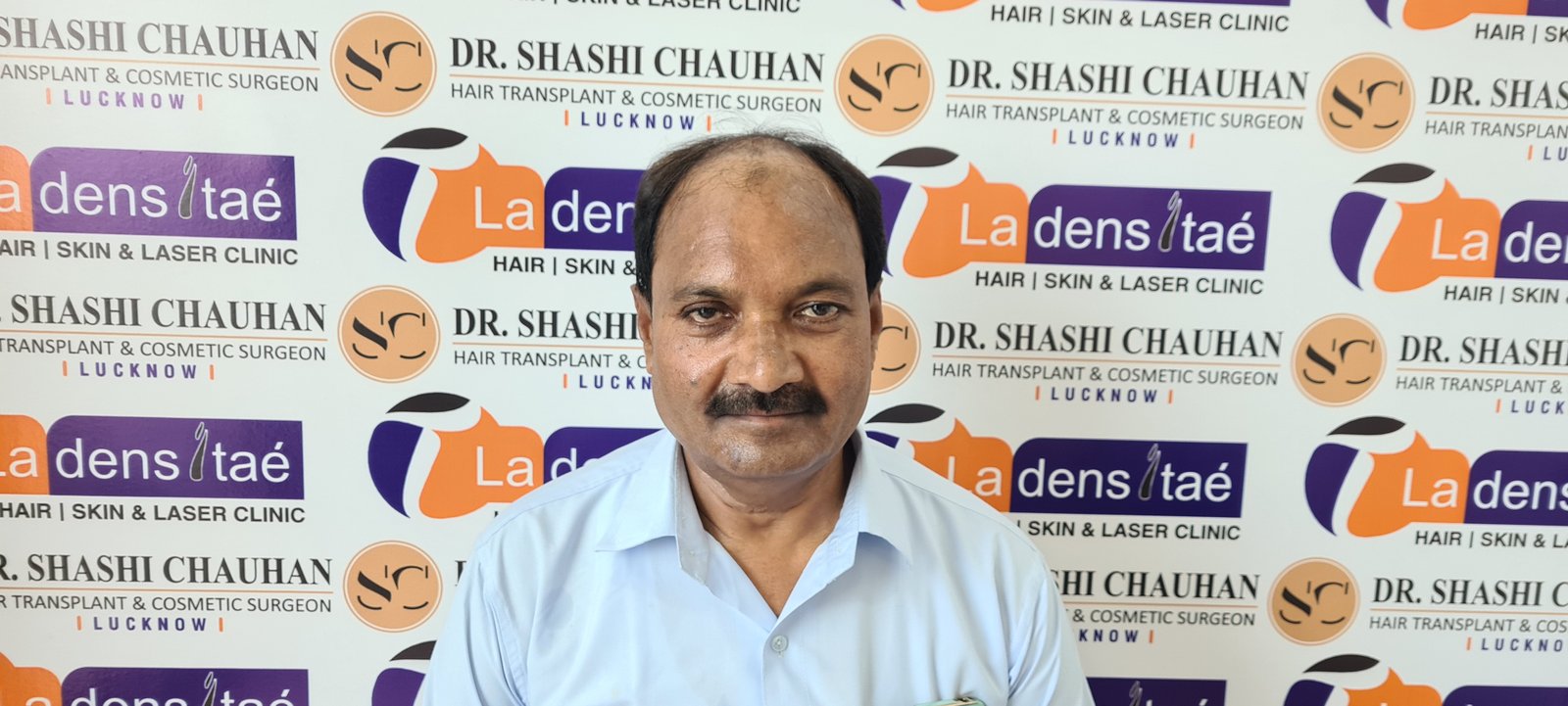 AK Singh Before Hair Transplant